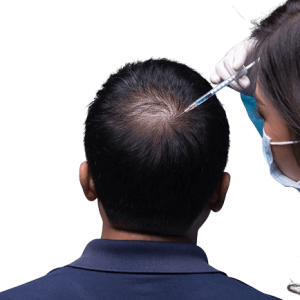 Best Hair Treatments After Transplant