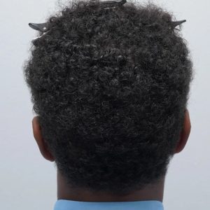 Curly Hair Transplant: Is it Possible?