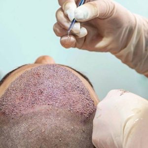 Hair Transplant Costs in Turkey: Is It Worth The Risk?