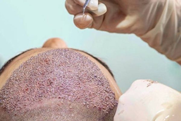 Hair Transplant Costs in Turkey: Is It Worth The Risk?