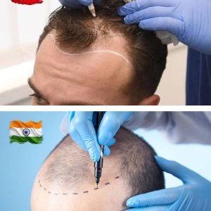 Hair Transplant Turkey vs India