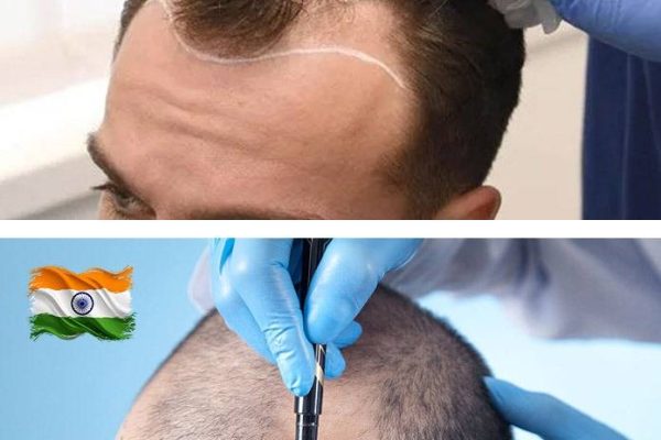 Hair Transplant Turkey vs India