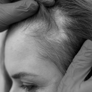 Hair Transplant for Women: What Makes It Different from Men’s Procedures