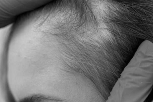 Hair Transplant for Women: What Makes It Different from Men’s Procedures