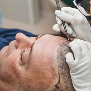 How long will hair transplants last?