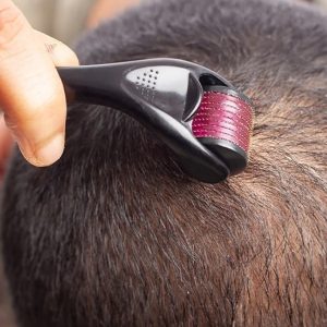 Microneedling (Dermarolling) for Hair Loss: Is It Effective?