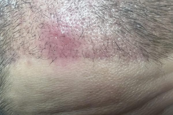 Pimples After a Hair Transplant