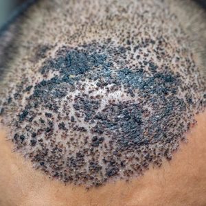 How To Avoid The Side Effects After Hair Transplant Surgery?