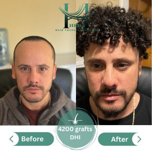 Before and After Hair Transplant Results