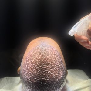 hair transplant aftercare
