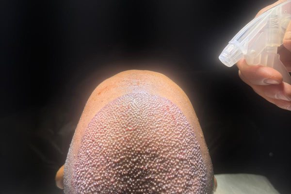 hair transplant aftercare