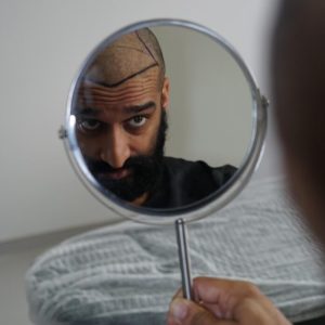 Is Hair Transplant Permanent?