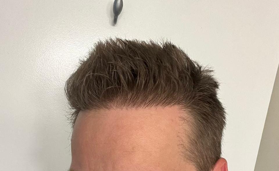 Successful Hair Transplant Results