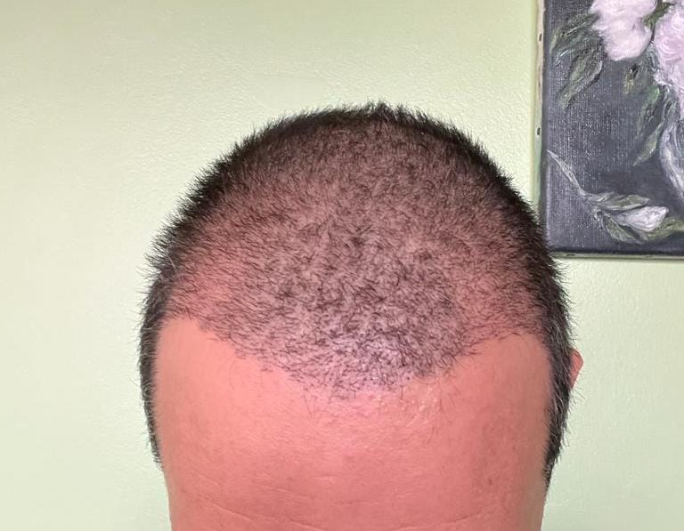 Hair Transplant Recovery 4-6 month