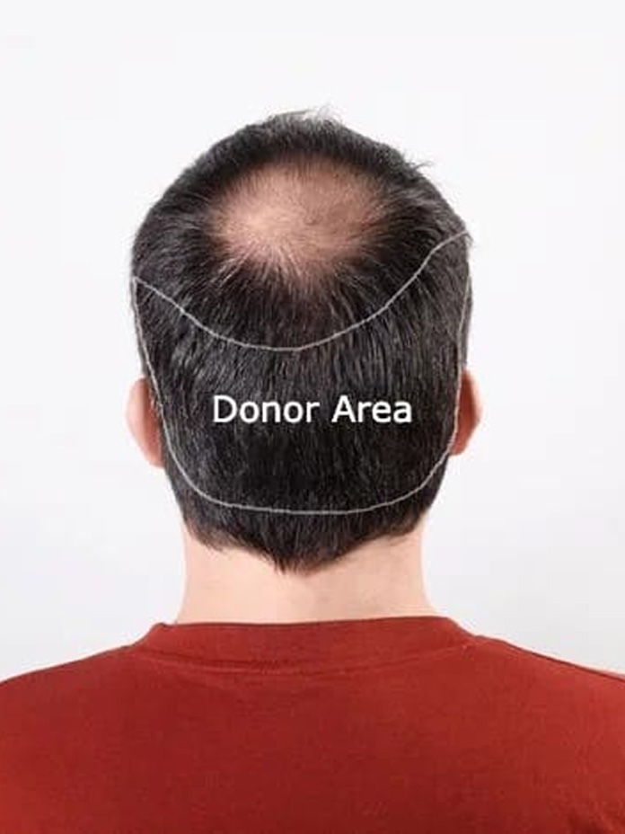 Donor Area in Hair Transplantation