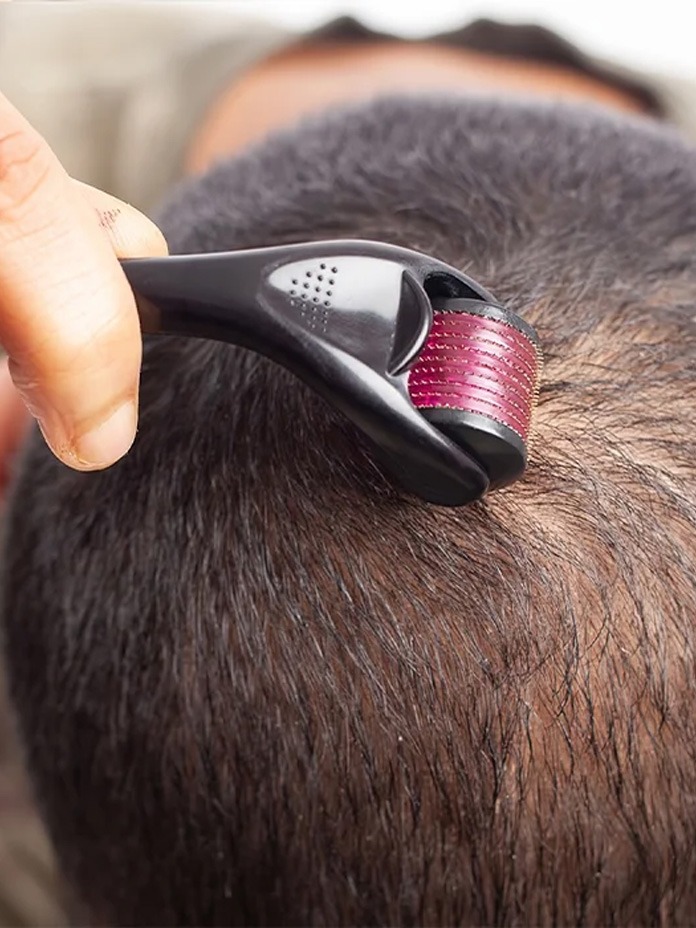 Microneedling for Hair Loss