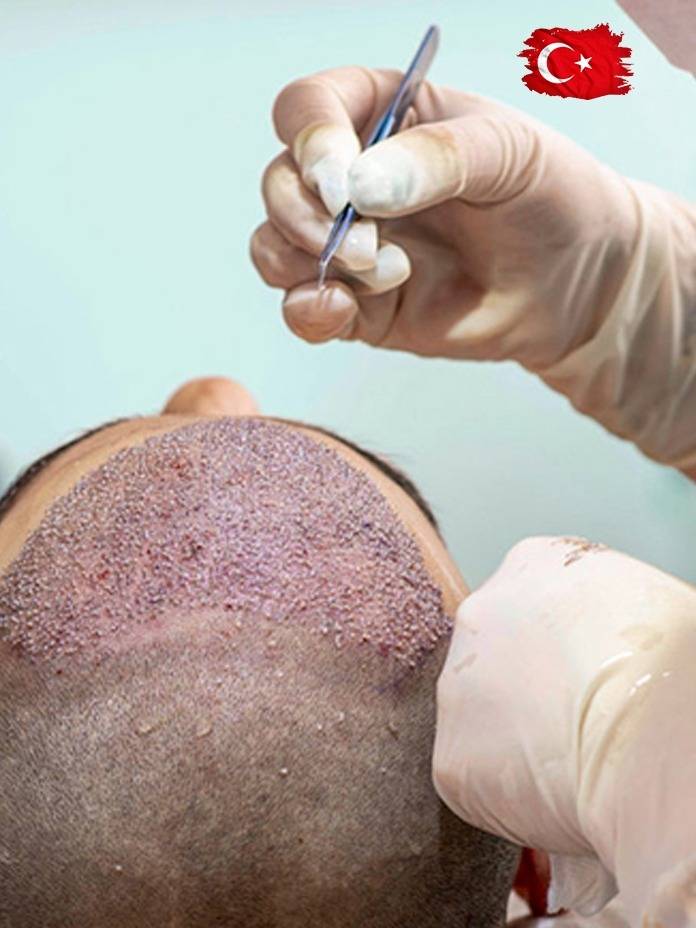 Hair Transplant Costs in Turkey: Is It Worth The Risk?