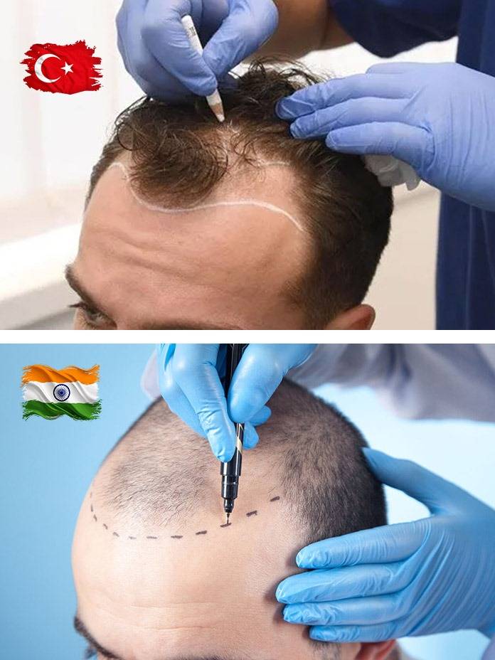Hair Transplant Turkey vs India