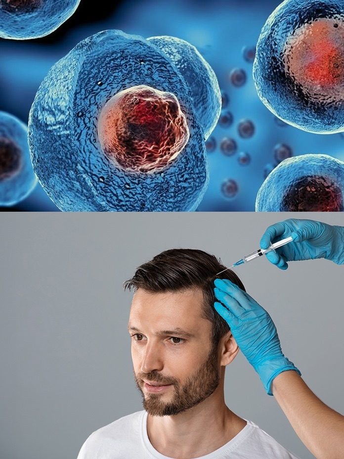 Stem Cell Therapy vs. PRP: Which Hair Loss Treatment Is Right For You?