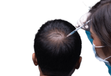 Best Hair Treatments After Transplant