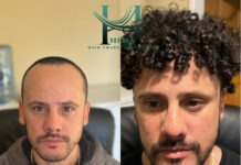 Before and After Hair Transplant Results before and after