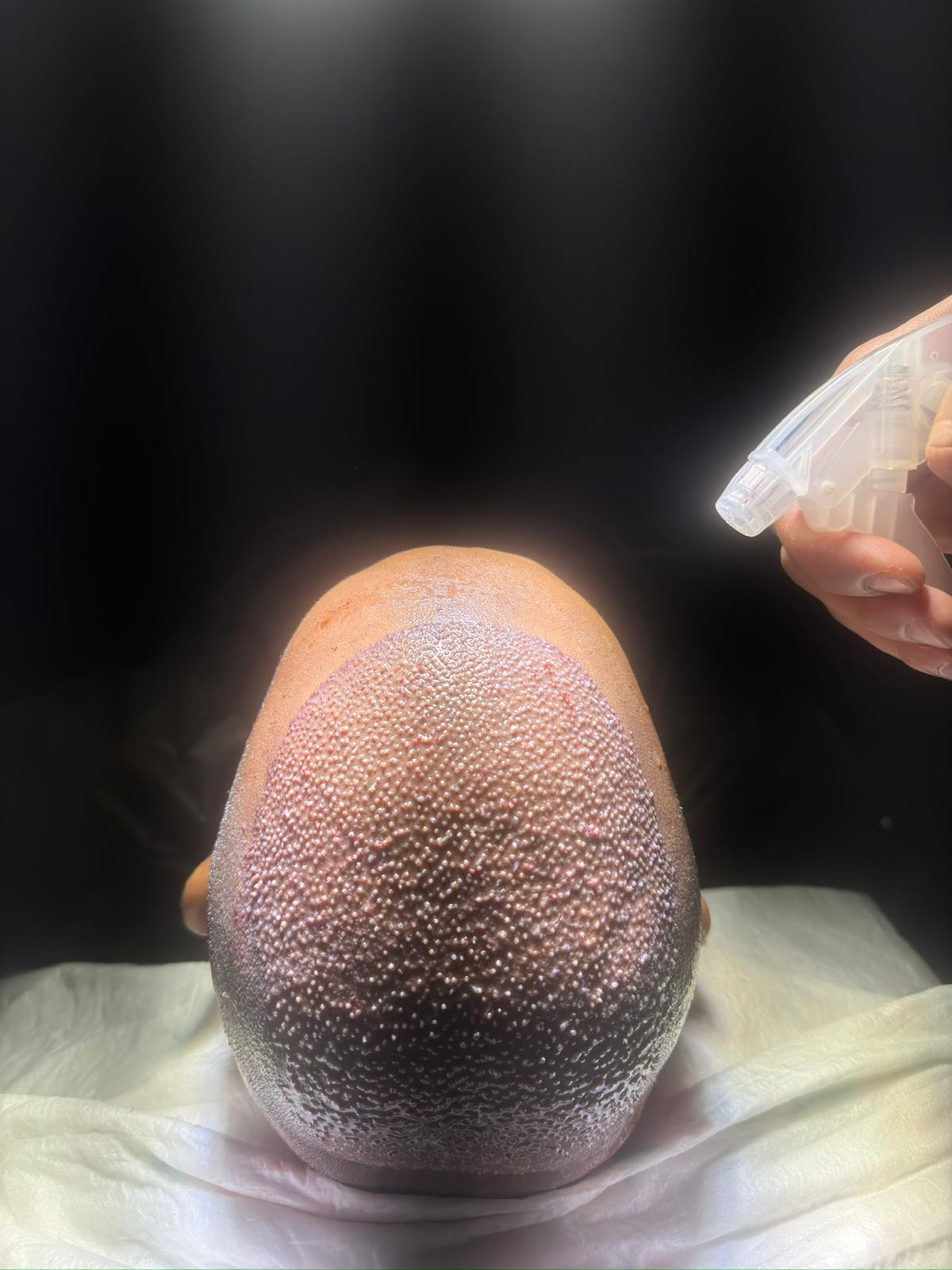 hair transplant aftercare