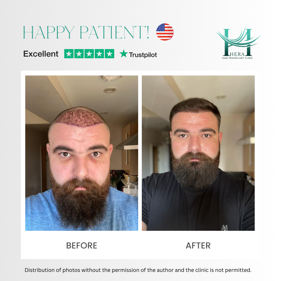 hera hair solutions before and after photo 3