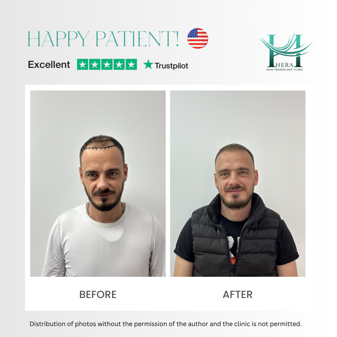 hera hair solutions before and after photo 5