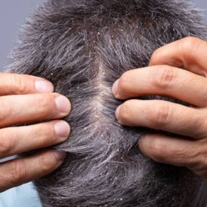 Can Dandruff Cause Hair Loss? An In-Depth Look