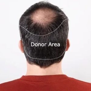 Donor Area in Hair Transplantation: Where is the Donor Site?