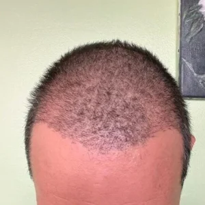 Hair Transplant Recovery: What to Expect After Your Procedure