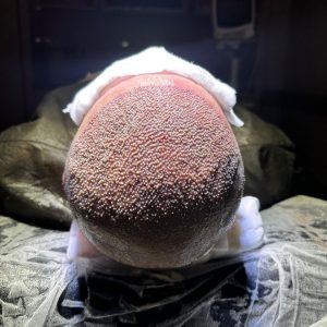 Fibroblast Stem Cells Hair Transplant in Turkey: