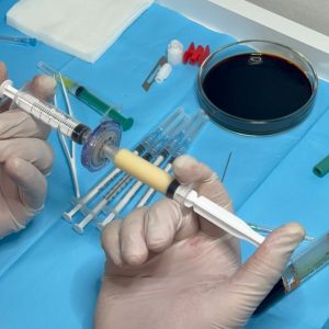 Stem cells applied to scalp after hair transplant for faster healing.