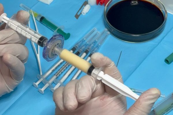 post-transplant stem cells after hair transplant